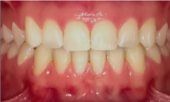 prije i poslije suresmile prozirni aligneri prozirne udlage