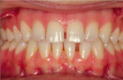 prije i poslije suresmile prozirni aligneri prozirne udlage