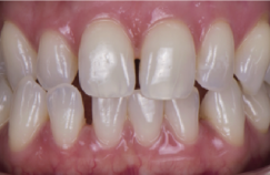 prije i poslije suresmile prozirni aligneri prozirne udlage