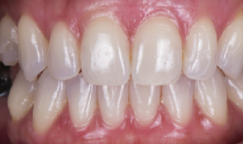 prije i poslije suresmile prozirni aligneri prozirne udlage