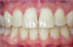 prije i poslije suresmile prozirni aligneri prozirne udlage