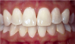 prije i poslije suresmile prozirni aligneri prozirne udlage